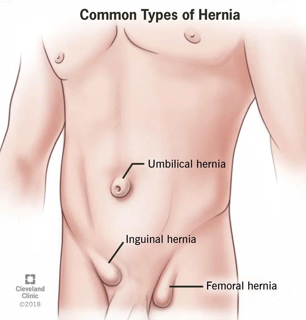 What is a hernia? Types and treatment of hernia [WE EXPLAIN]