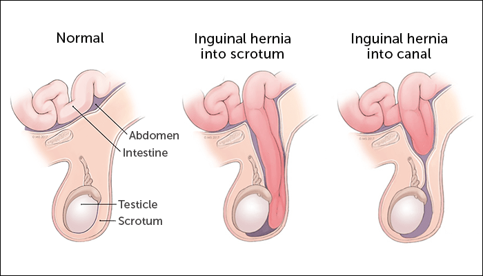 What is a scrotal hernia?