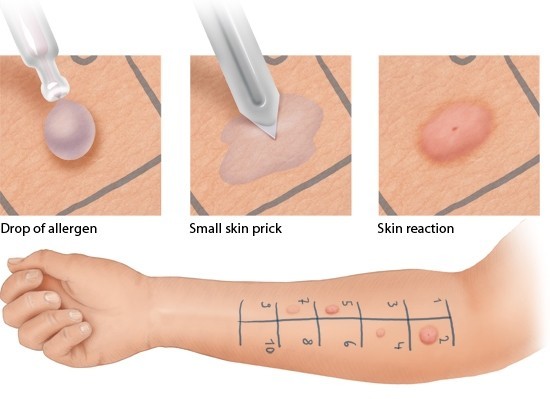 What is an indication for allergy testing?