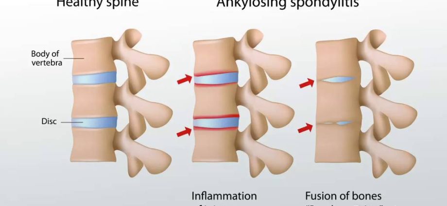 What is ankylosis?