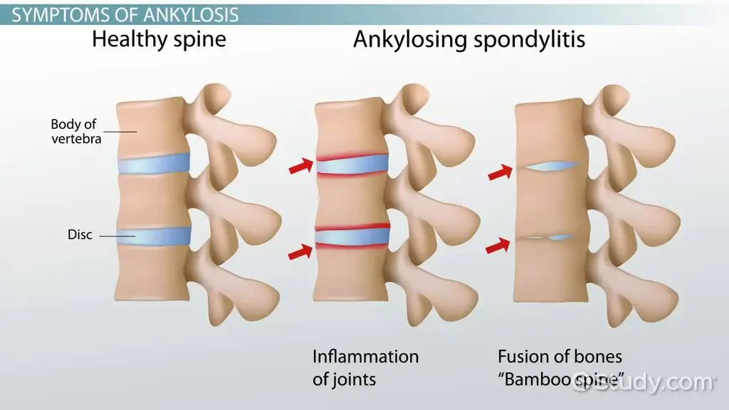 What is ankylosis?