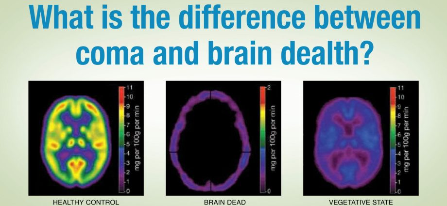 What is brain death?