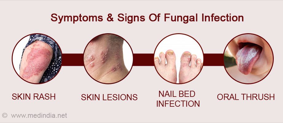 What is fungal infection in the body and what are its symptoms?