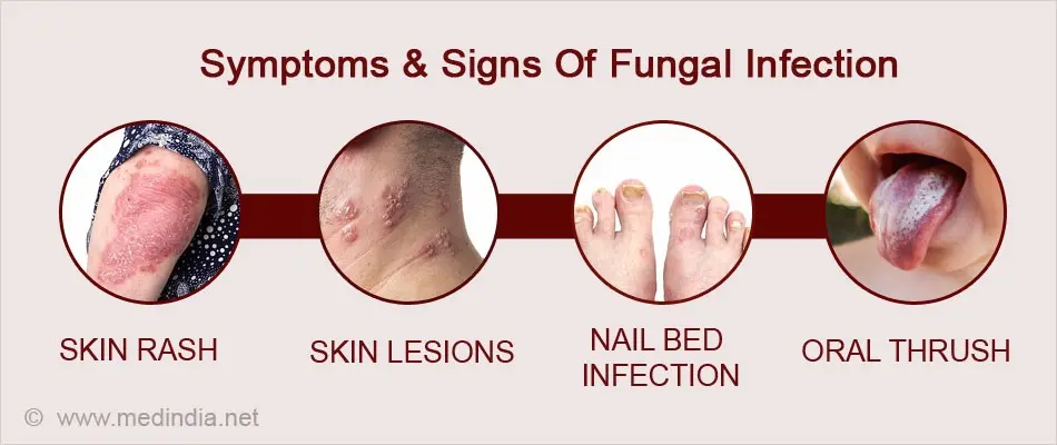 What is fungal infection in the body and what are its symptoms?