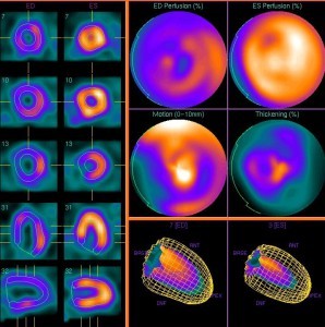 What is heart scintigraphy?