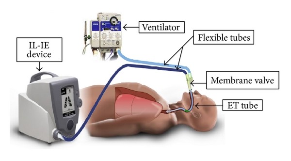 What is insufflation?