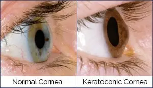 What is keratoconus?