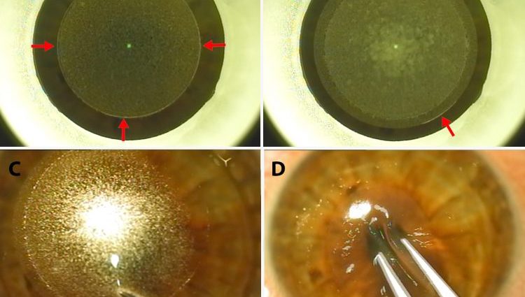 What is laser vision correction?