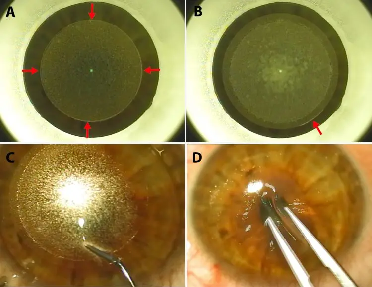 What is laser vision correction?