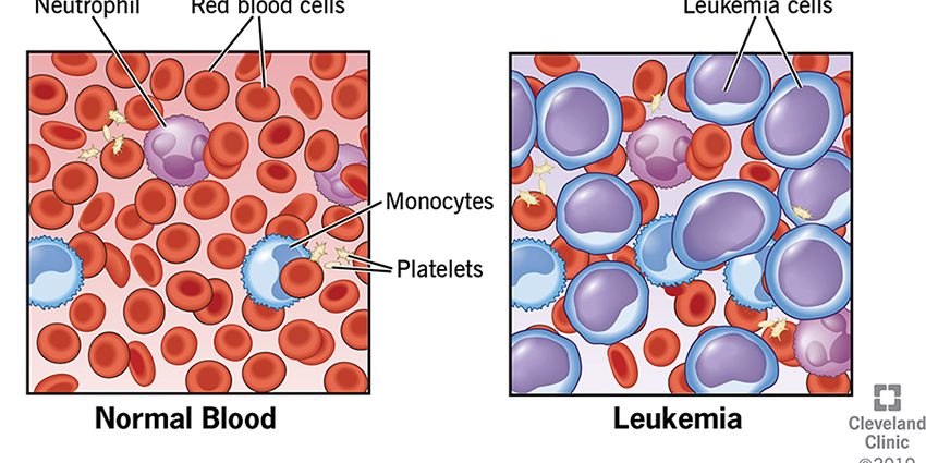 What is Leukemia?