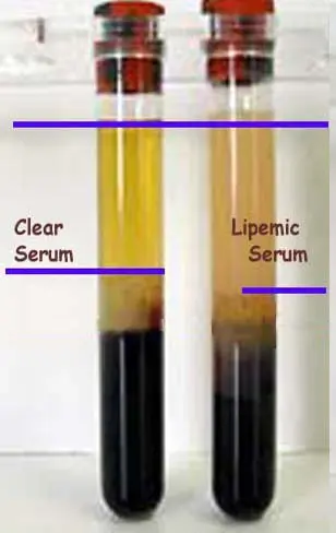 What is lipemia?