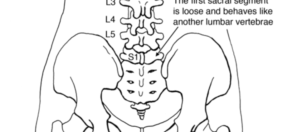 What is lumbalization?