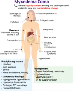 What is myxedema and what are its causes?