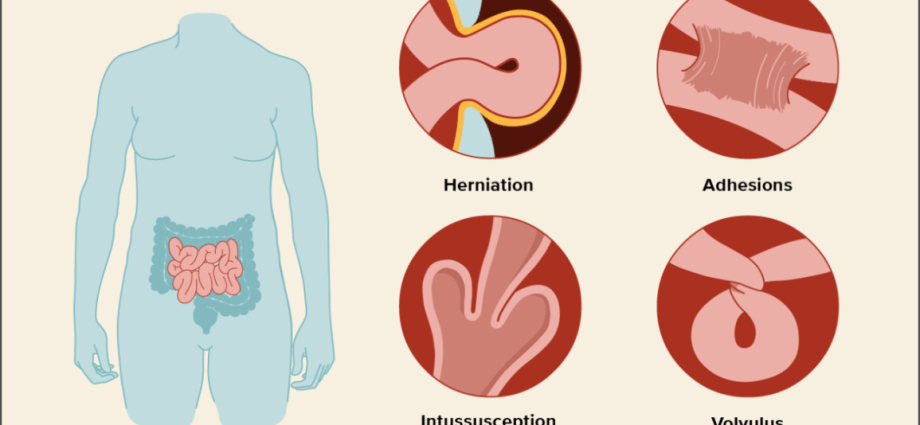 What is obstruction? Causes, diagnosis and treatment of constipation