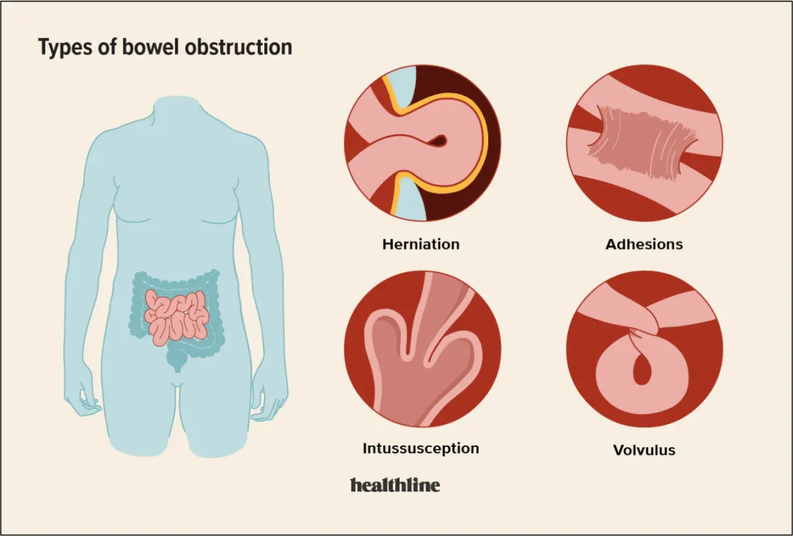 What is obstruction? Causes, diagnosis and treatment of constipation