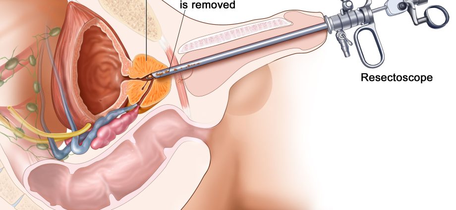 What is prostate cancer surgery?