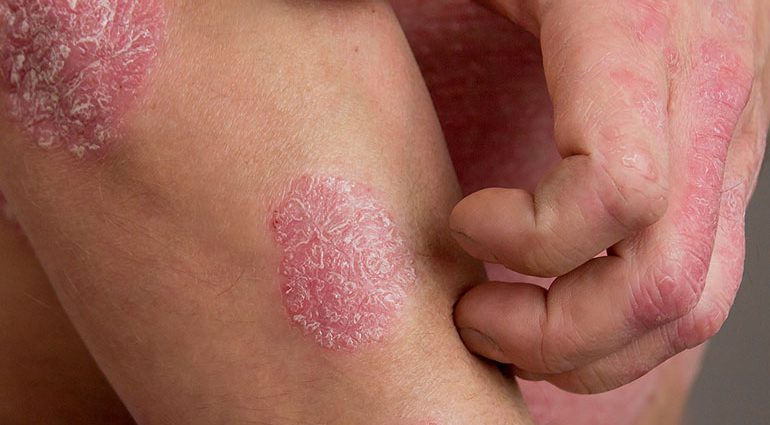 What is psoriasis? Difficult life of the sick, treatment