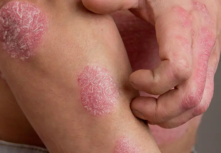 What is psoriasis? Difficult life of the sick, treatment