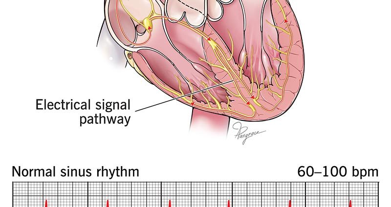 What is sinus bradycardia?