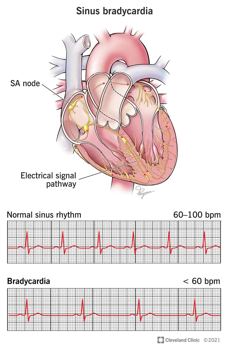 What is sinus bradycardia?