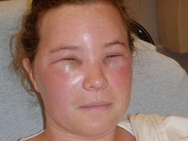 What is the benefit of a bee sting