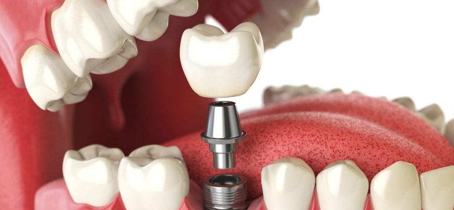 What is the cost of dental implants?