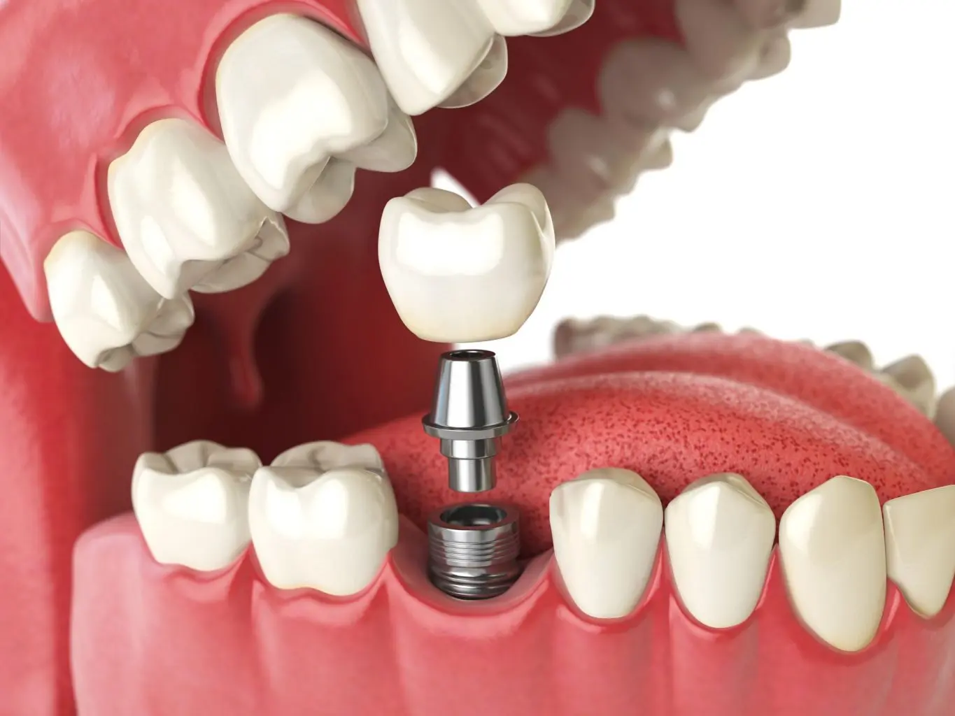 What is the cost of dental implants?