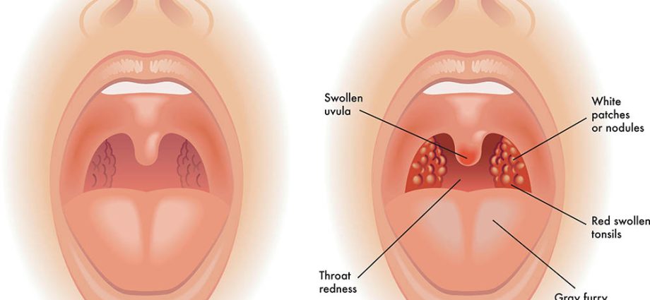 What is the difference between a cold and tonsillitis?