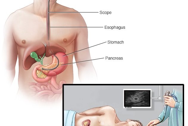 What is the EUS test?