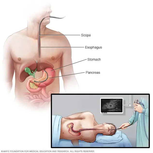 What is the EUS test?