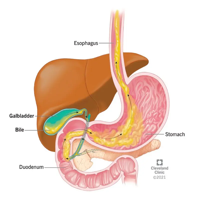 What is the treatment and diet for bile reflux?