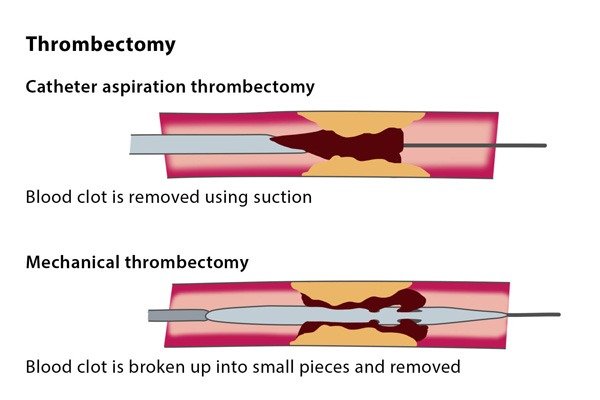 What is thrombectomy?