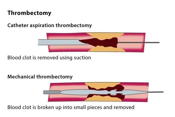 What is thrombectomy?