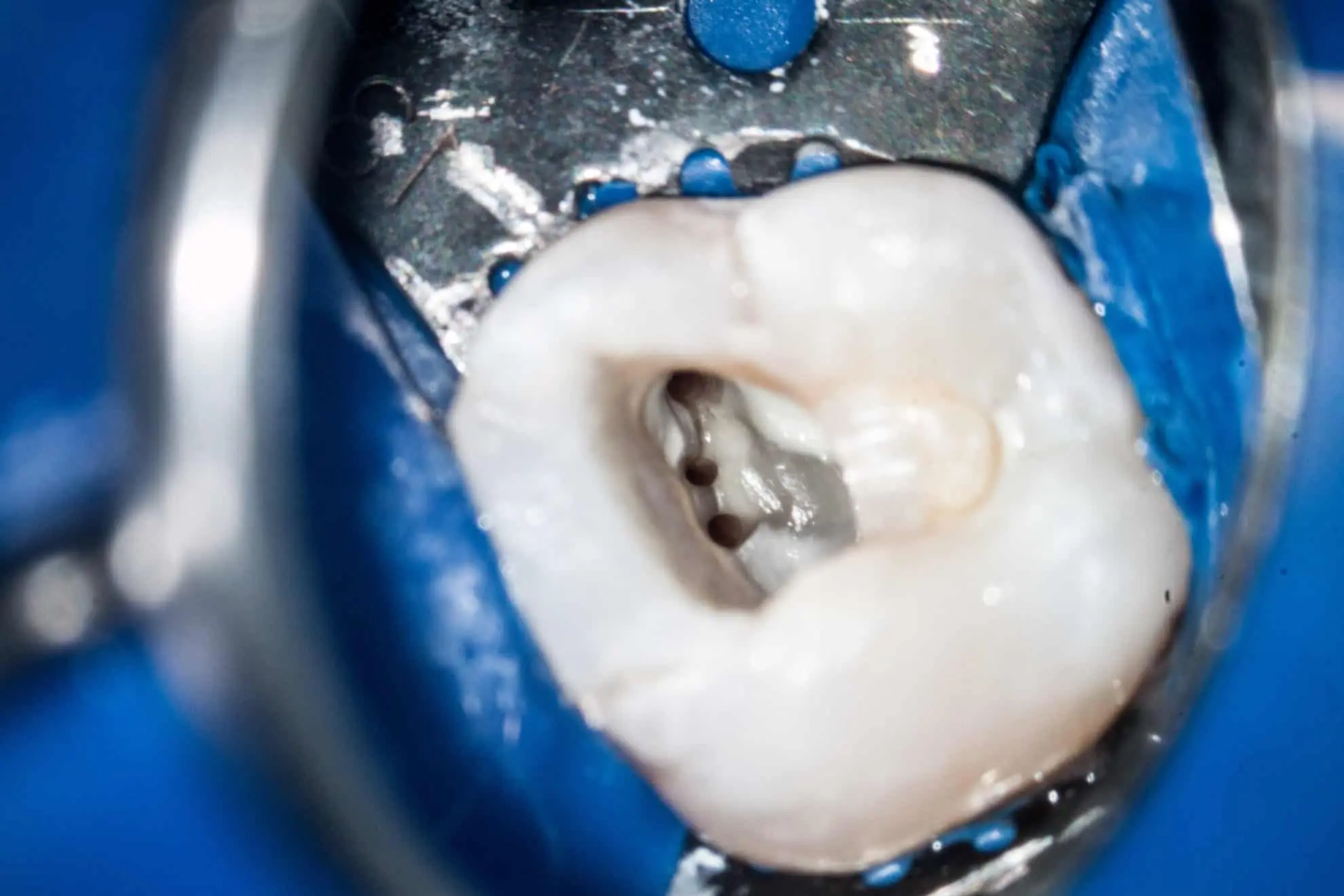 What is tooth root canal treatment under the microscope?