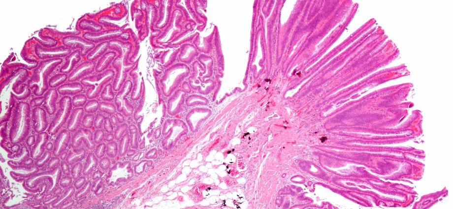 What is tubular adenoma?