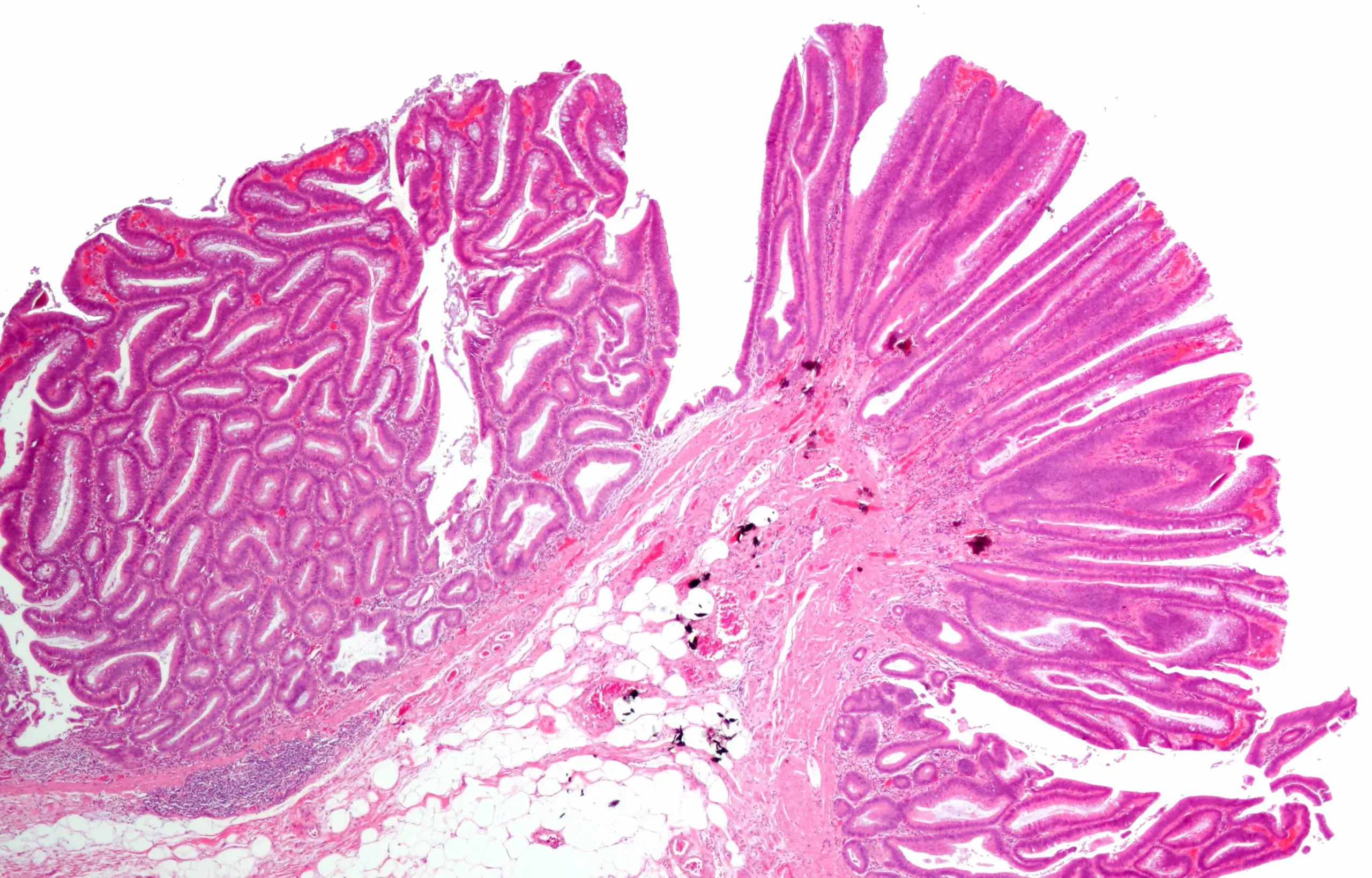 What is tubular adenoma?