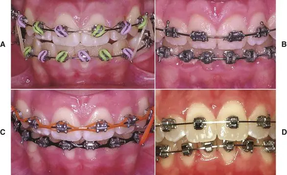 What should you know about classic orthodontic appliances?