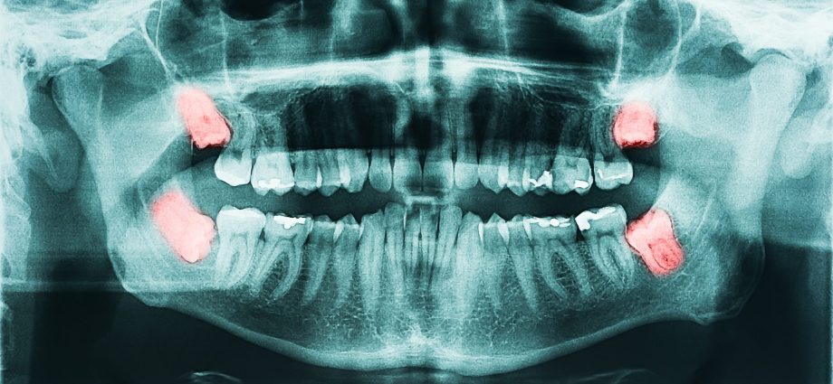 What should you know before having a tooth x-ray?