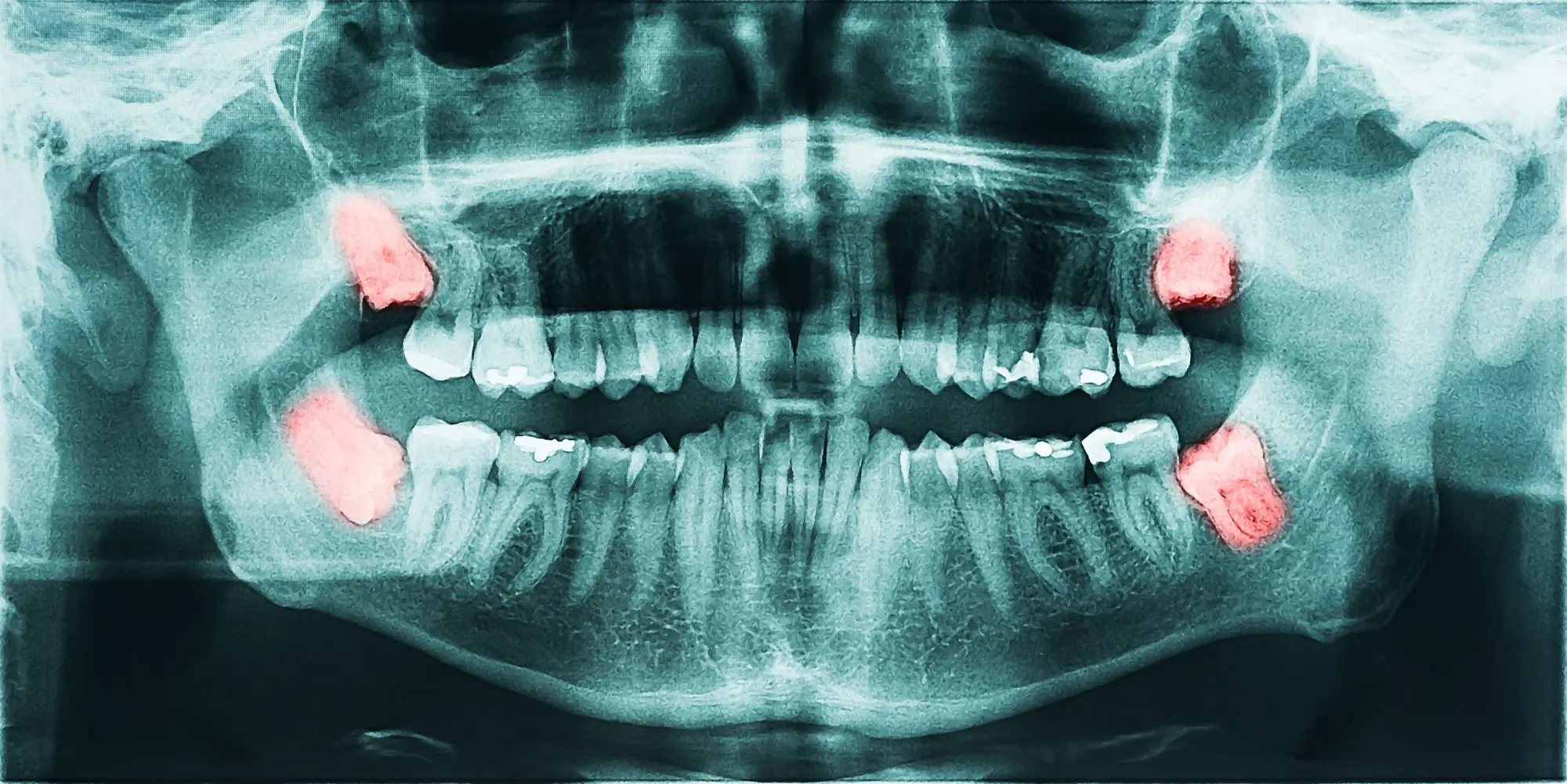 What should you know before having a tooth x-ray?