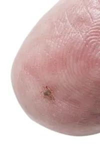 What to do when a tick gets stuck in the skin? Doctor: do not go around and remember that the ED has more urgent matters