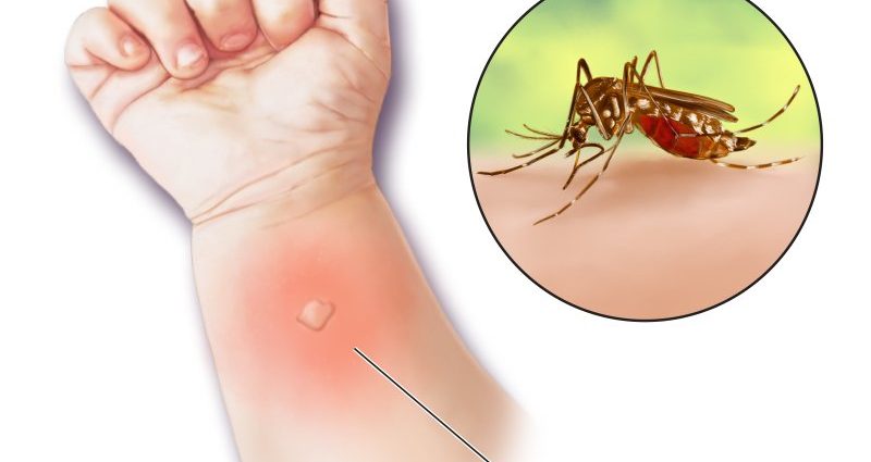 What to do when you are allergic to mosquito saliva?