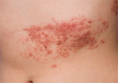 What You Need To Know About Boston Disease? Rash with Boston and chicken pox