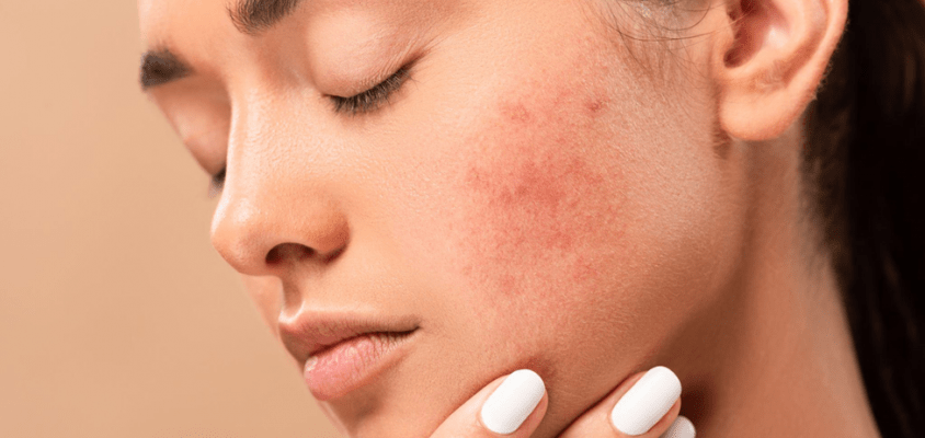 What you should know about acne