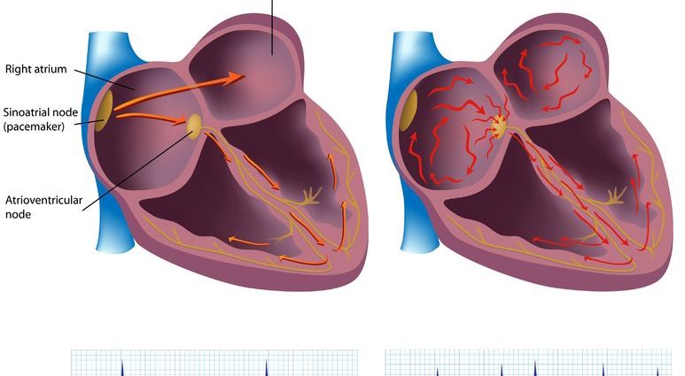 What&#8217;s on your heart? Atrial fibrillation. The nine signals your body sends out