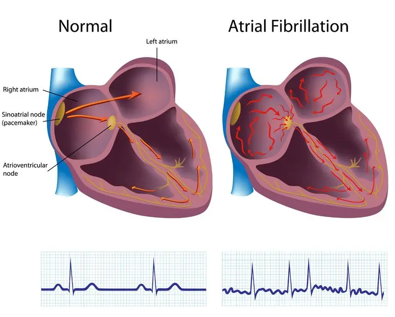 What&#8217;s on your heart? Atrial fibrillation. The nine signals your body sends out