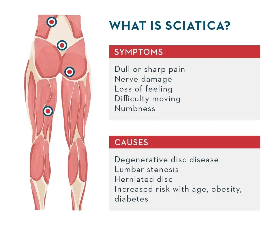 When and why does the sciatic nerve hurt? Causes, Symptoms and Treatment