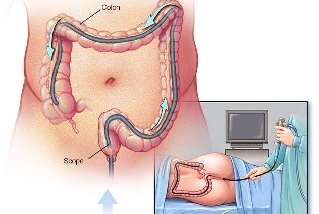 When for a colonoscopy?