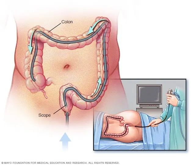 When for a colonoscopy?