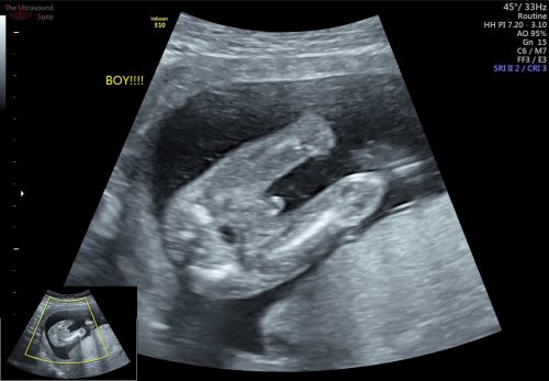 When is it possible to recognize a child&#8217;s gender on ultrasound?