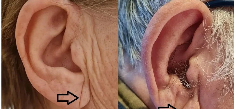 When is it worth treating a diagonal wrinkle?